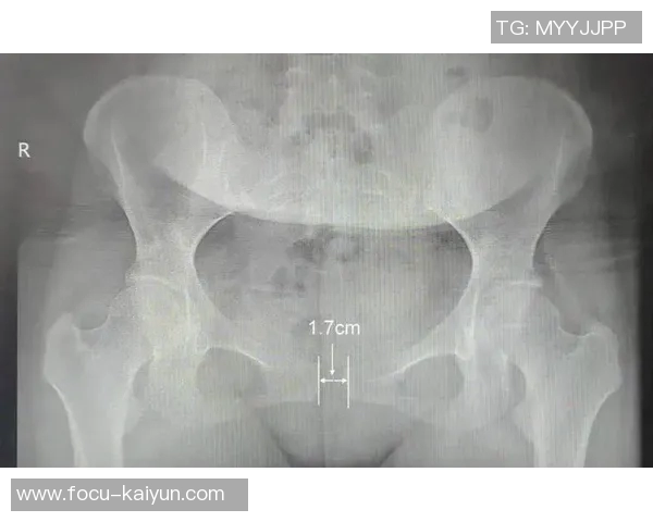医生：耻骨痛降低了亚马尔50%的运动能力，使其远离最佳状态